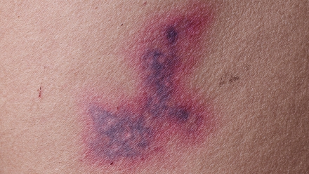CARE Bruise Animation